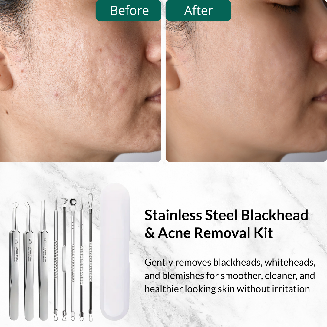 Pimple Pooper Tool & Professional Acne/Blackhead Removal Kit (8 PCS)
